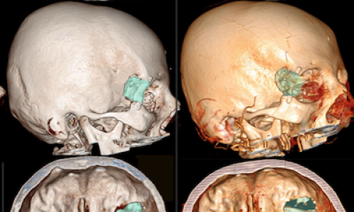 lateral-transorbital-approach-an-alternative-microsurgical-route-for-supratentorial-cerebral-aneurysms