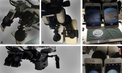 low-cost-stereoscopic-recordings-of-neurological-surgery-operative-microscopy