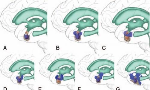 microsurgical-resection-of-tuberculum-sellae-meningioma-via-pterional-craniotomy-with-extradural-anterior-clinoidectomy-and-optic-unroofing